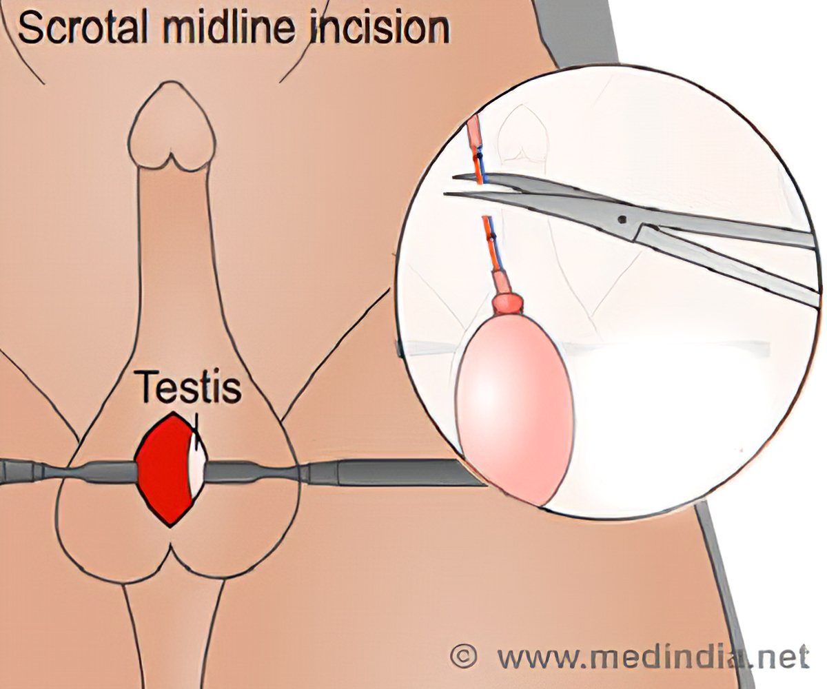 abiola adegbite recommends Castration Video Human Surgery