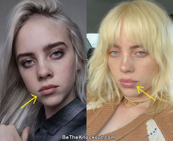 benjamin gillikin add photo billie eilish boob job