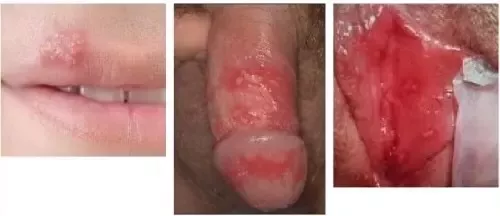 chen sai add photo blowjob with cold sore