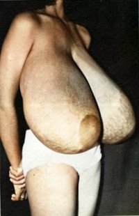 balamurali bakthavachalam share macromastia tits in tops photos