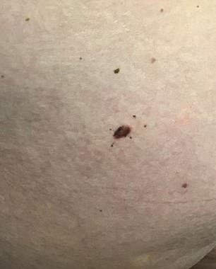 allison sheahan recommends mole on bum cheek pic